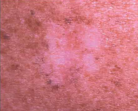 melanoma