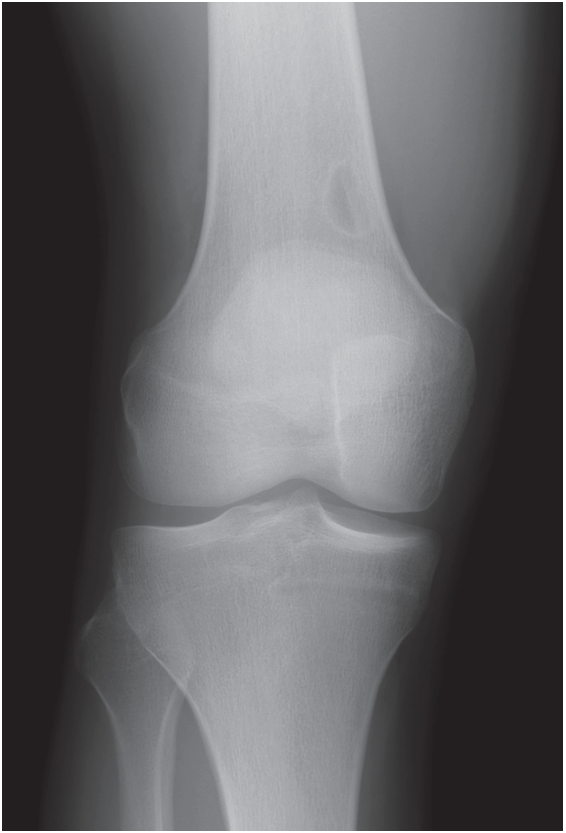 nonossifying fibroma