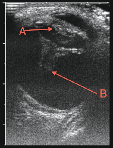 Hyphema in Spondyloepiphyseal Dysplasia Congenita