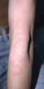 atopic dermatitis