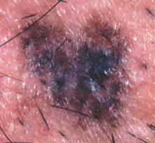 melanoma
