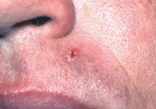basal cell carcinoma