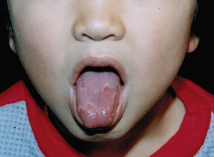 Red Patches On A 10 Year Old s Tongue Consultant360