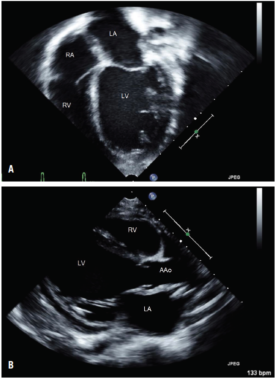 ventricle