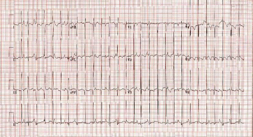 atrioventricular dissociation