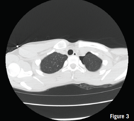 pneumothorax
