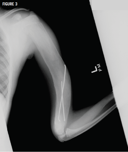 polyostotic fibrous dysplasia