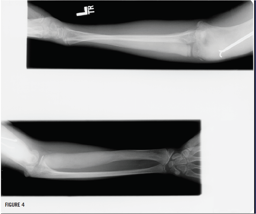 polyostotic fibrous dysplasia