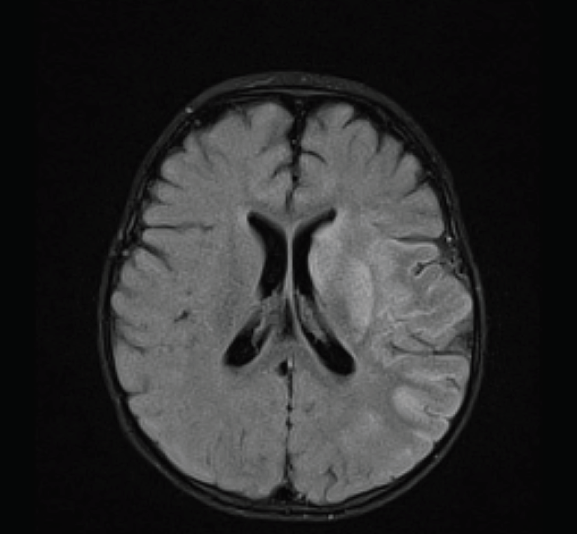 acute infarction