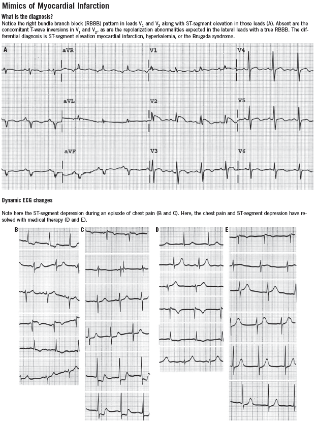 ECG changes