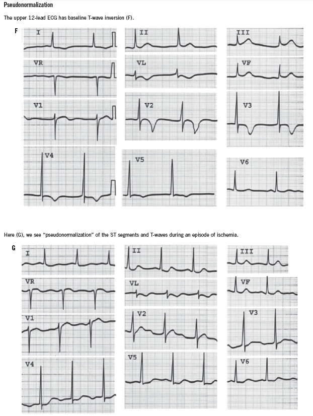 pseudonormalization
