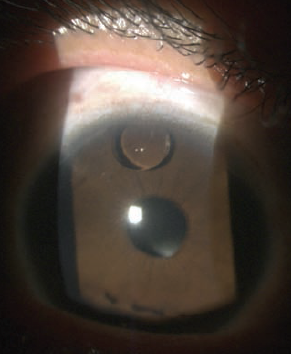 oil in anterior chamber