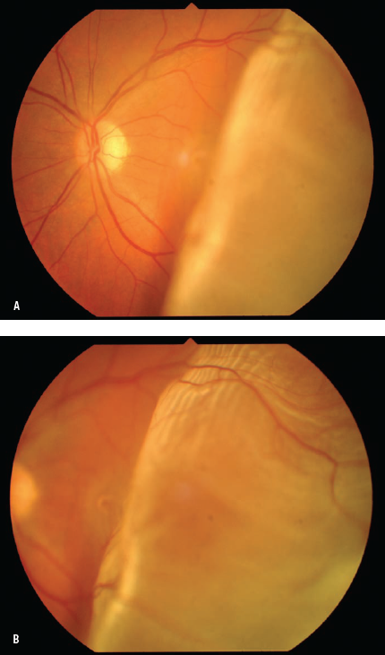 retinal detachment