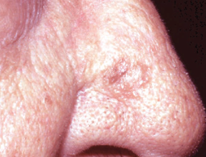 actinic keratosis