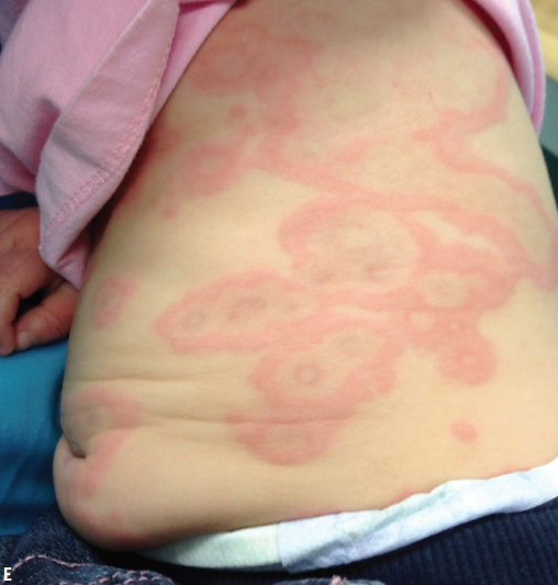 Urticaria Multiforme Consultant360