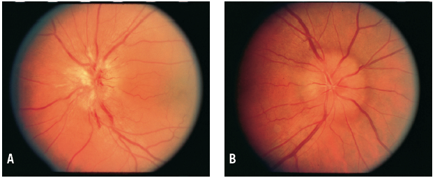Pseudotumor Cerebri