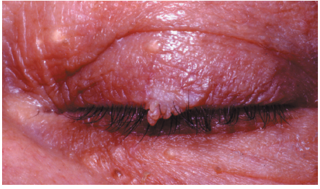 Acrochordons or Skin Tags