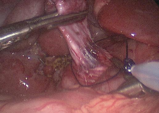 cyst