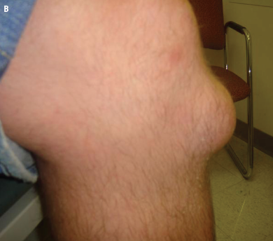 prepatellar bursitis