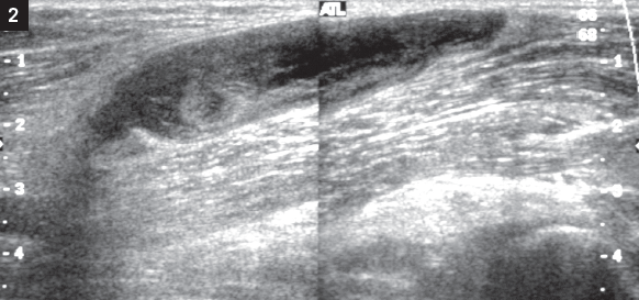 vascular ultrasonography
