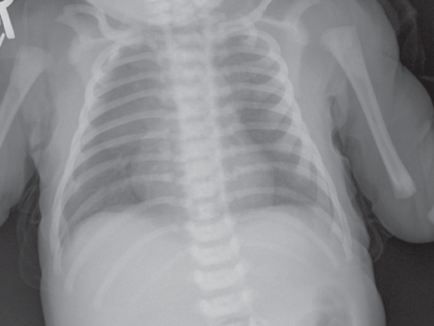 pneumopericardium
