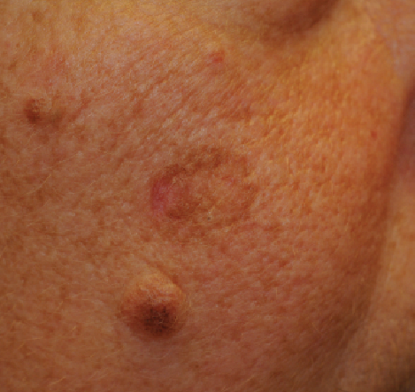 keratosis
