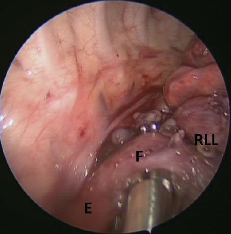 fistula