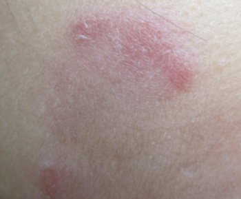 lupus