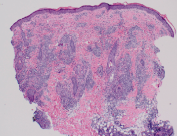 lupus