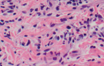 lupus