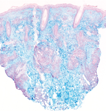 lupus