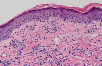 lupus