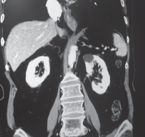 chest ct