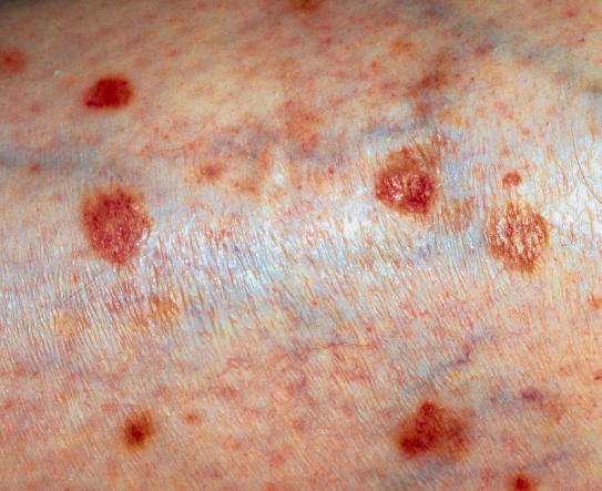 actinic keratoses