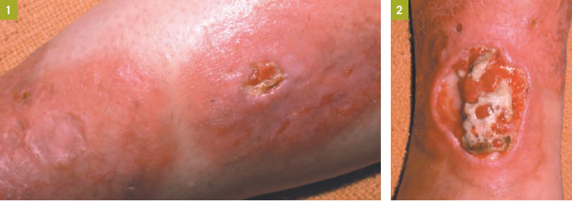 pretibial rash