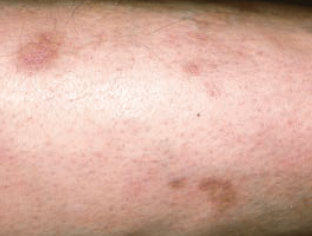 dermopathy