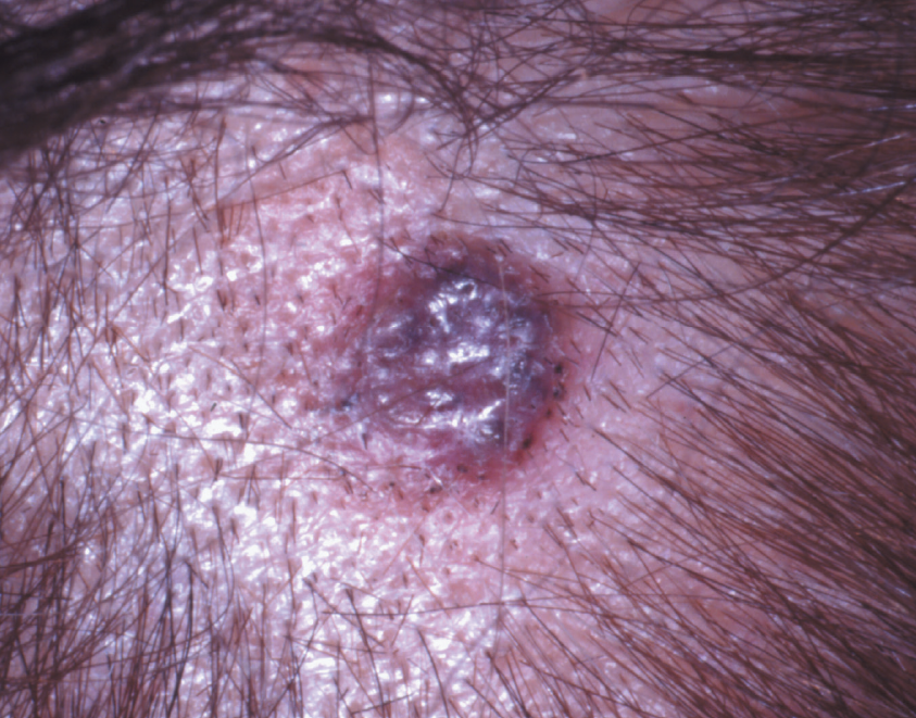 melanoma