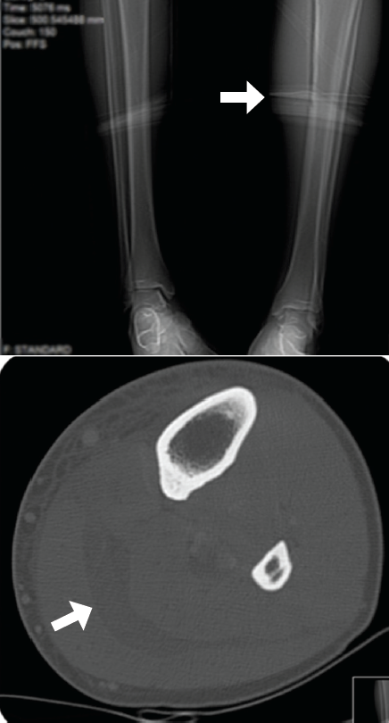 tomography