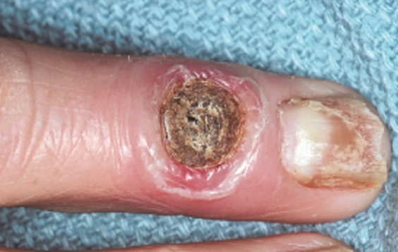 vasculopathy