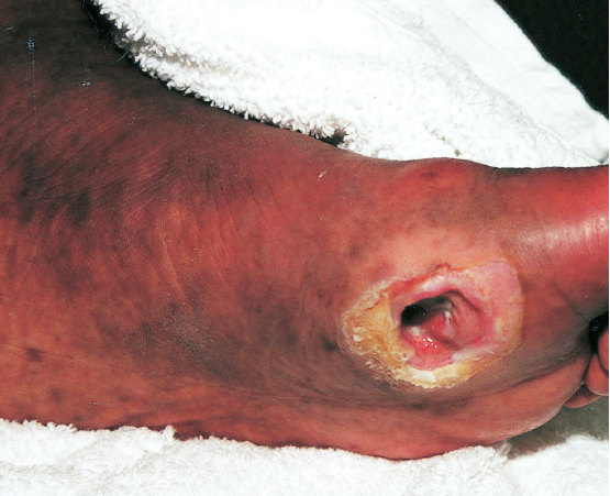 foot ulcer