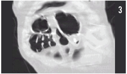 pneumatosis