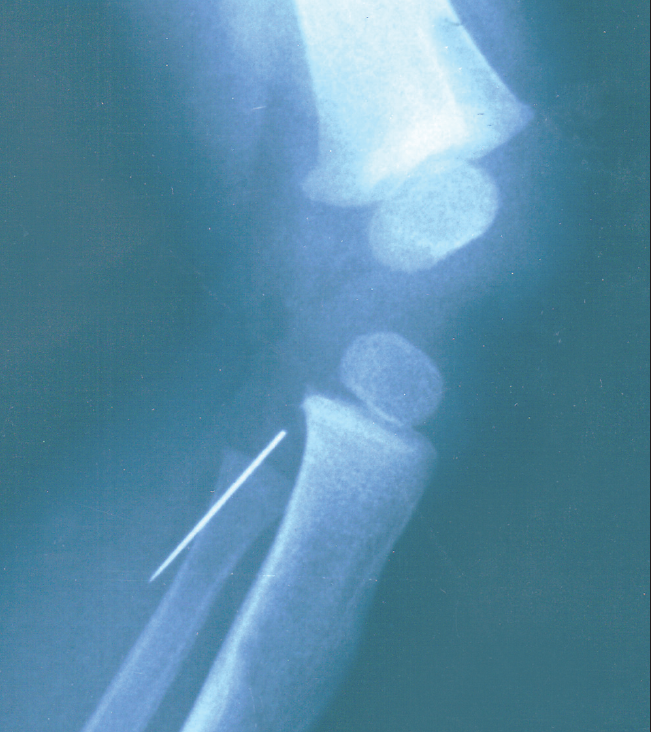 needle