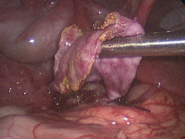 cyst