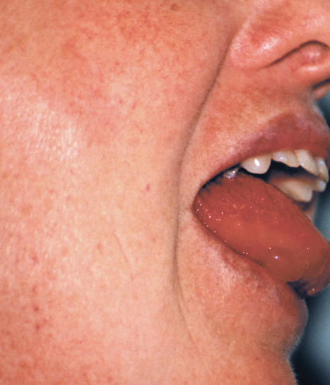 angioedema
