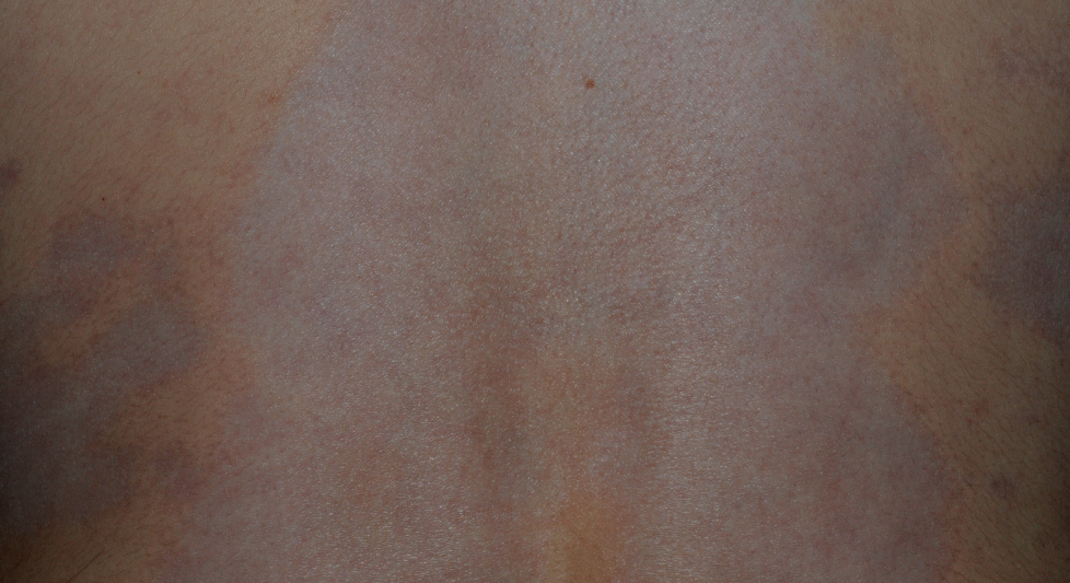 morphea