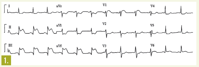 ekg