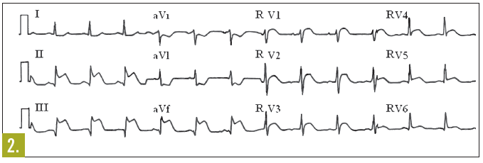 ekg