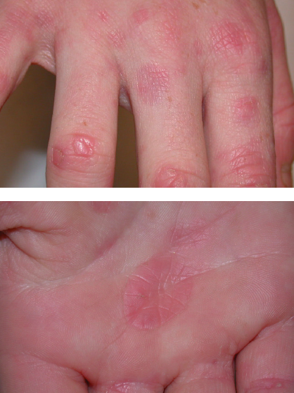 maculopapular rash hands