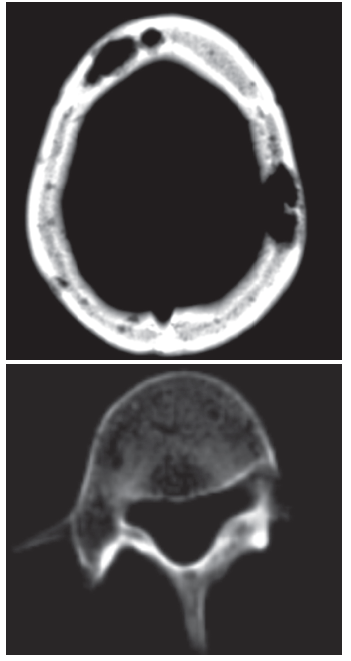 Mycobacterium Aviumintracellulare Complex Infection