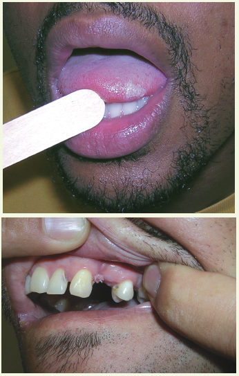 Oral Hairy Leukoplakia